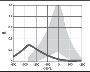 <p>What type of tympanogram is this and what would it typically suggest</p>