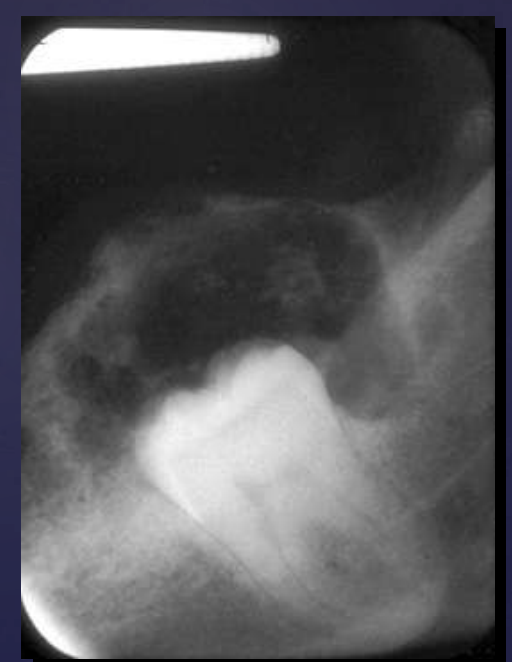 <p>• Well circumscribed, corticated</p><p>• Mixed density- central radiolucency with radiopaque foci</p><p>• Maybe associated with unerupted tooth</p><p>• Expansile- expands cortex</p><p>• Root resorption possible</p>