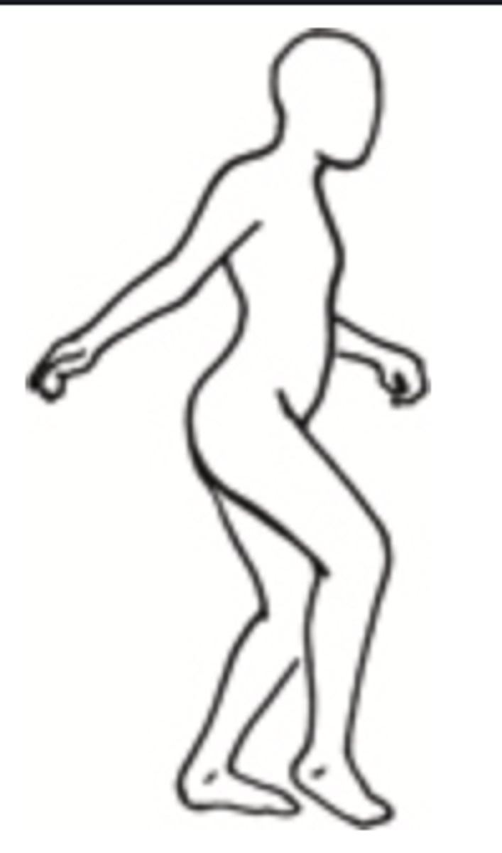 <p>- An abnormal gait in which the person's pelvis moves up and down with walking</p><p>- Can be caused by weak hips</p>