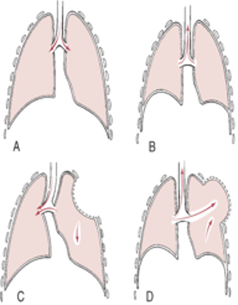 <p>paradoxical movement; hypoxemia and hypoventilation</p>