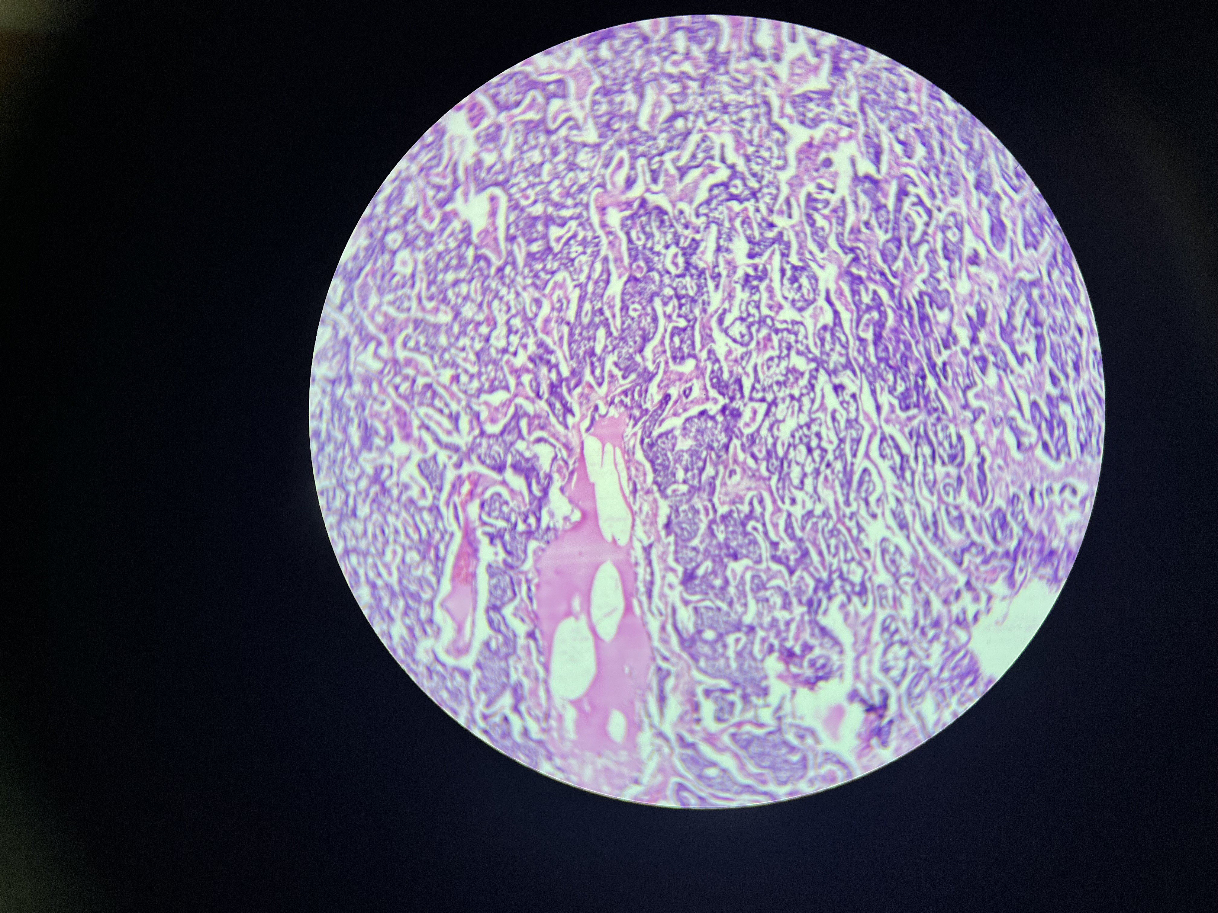 <p>A benign tumor of the parathyroid gland that results in increased secretion of parathyroid hormone (PTH), leading to hypercalcemia and associated symptoms such as weakness, fatigue, and kidney stones. </p>