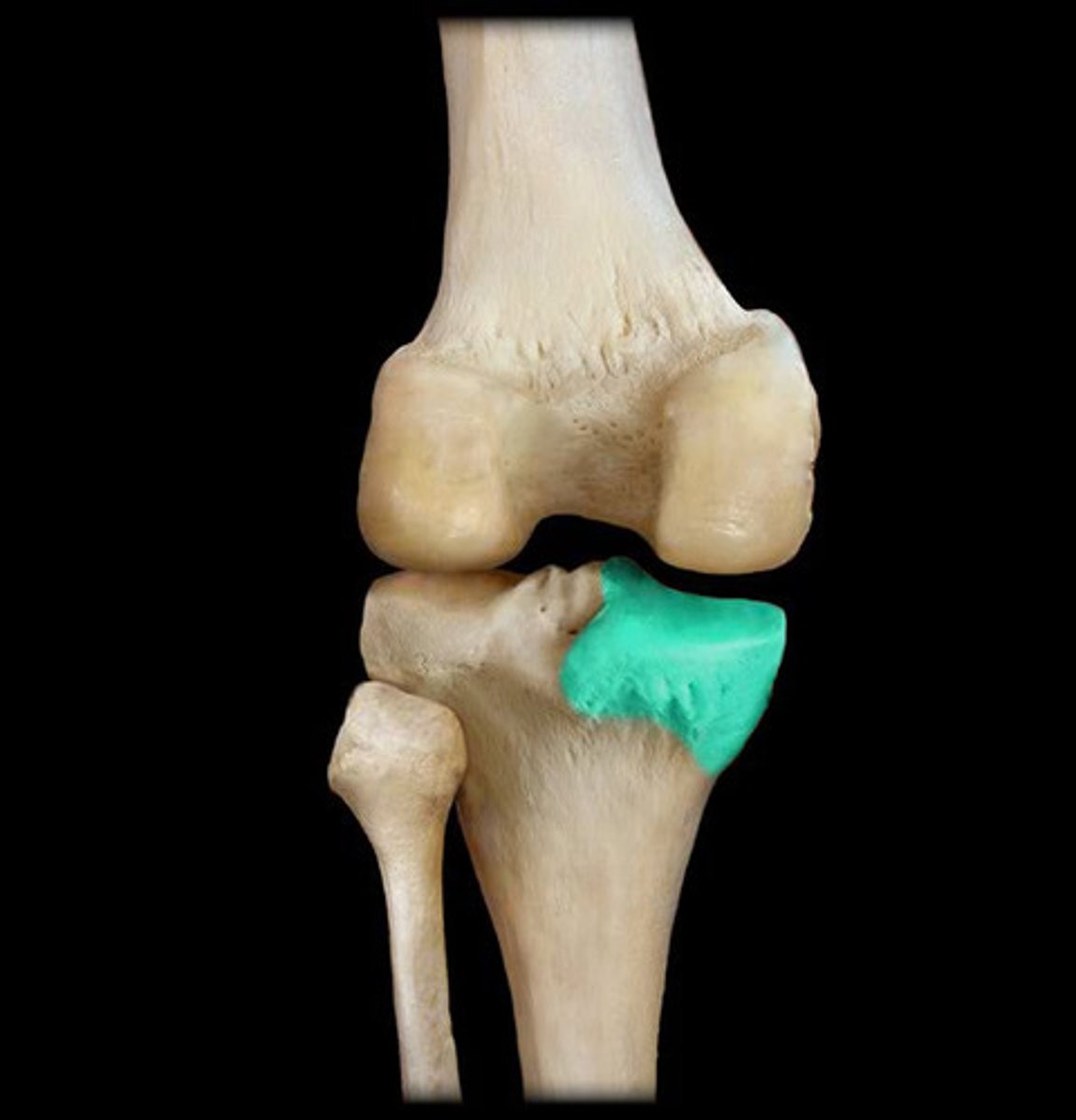 <p>The medial side of the tibial plateau</p>