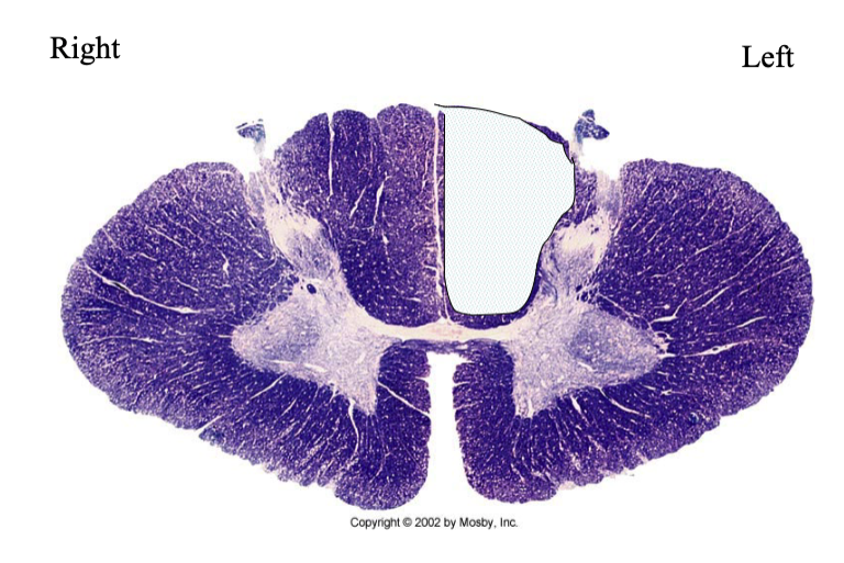<p>What findings would you expect to see in an individual with this lesion?</p>