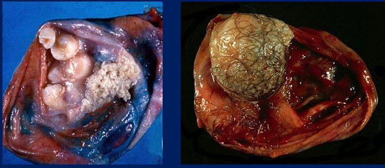 <p>Teratomas are tumors that arise from pluripotent stem cells, characterized by the presence of disorganized cell lineages derived from multiple germ layers.</p>