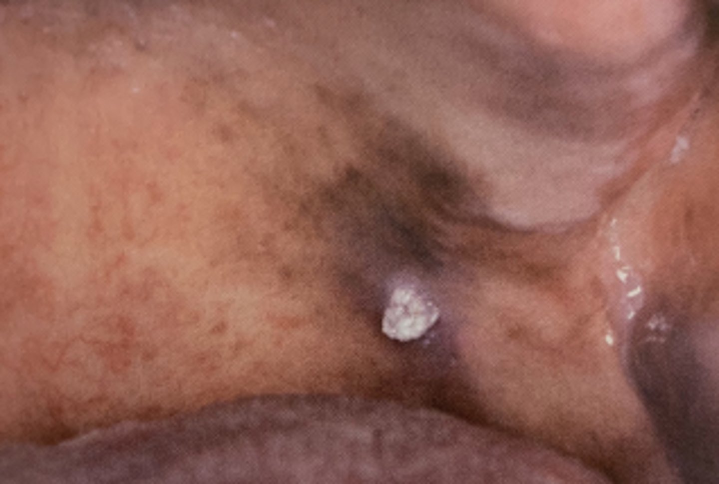 <p>AKA Common Wart</p><p>• soft, single, papillary, sessile</p><p>• pink or white</p><p>• associated with HPV</p><p>• common locations: lips, tongue, palate</p><p>• population: children/young adults</p>