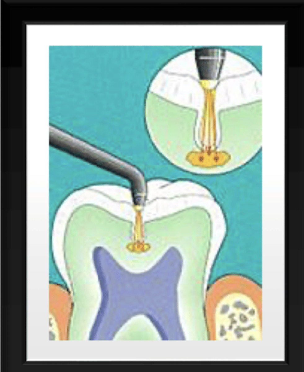<p>pyrphyrins (bacterial byproducts) reside in porous carious lesions</p><p>laser fluorescence transmits through the tooth reflecting on the porphyrins</p><p>reflected light has a longer wavelength, indicating a carious lesion</p>