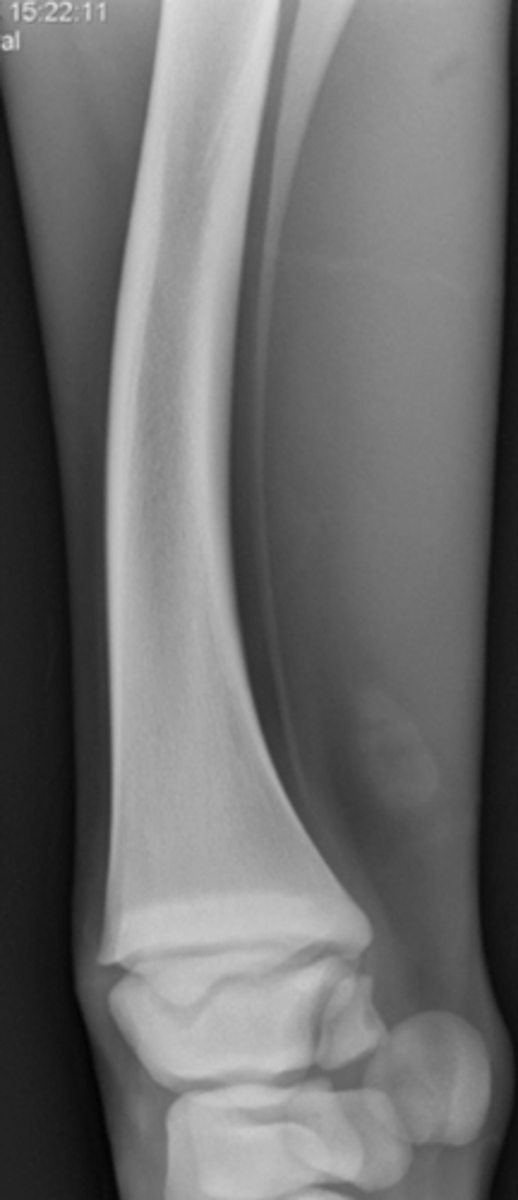 <p>What abnormality is shown?</p>