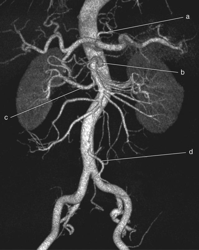 <p><span>Inferior Mesenteric Artery</span></p>