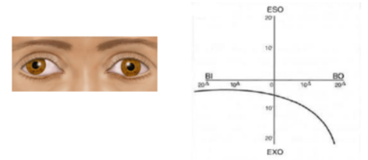 <p>forced vergence fixation disparity curve that represents an intolerance of forced convergence (BO) as seen in patients having exophoria. Appears as a flat slope on the BI side and a steep slope on the BO side. Seen in about 10% of people at near and 0% at distance.</p>