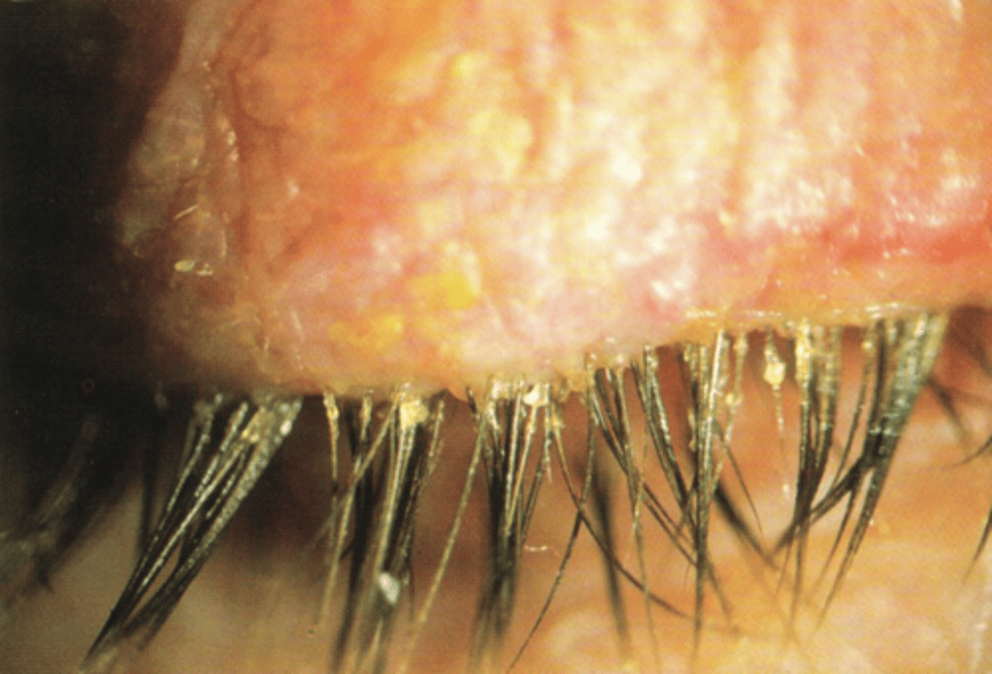 <p>What ocular condition is shown here?</p>