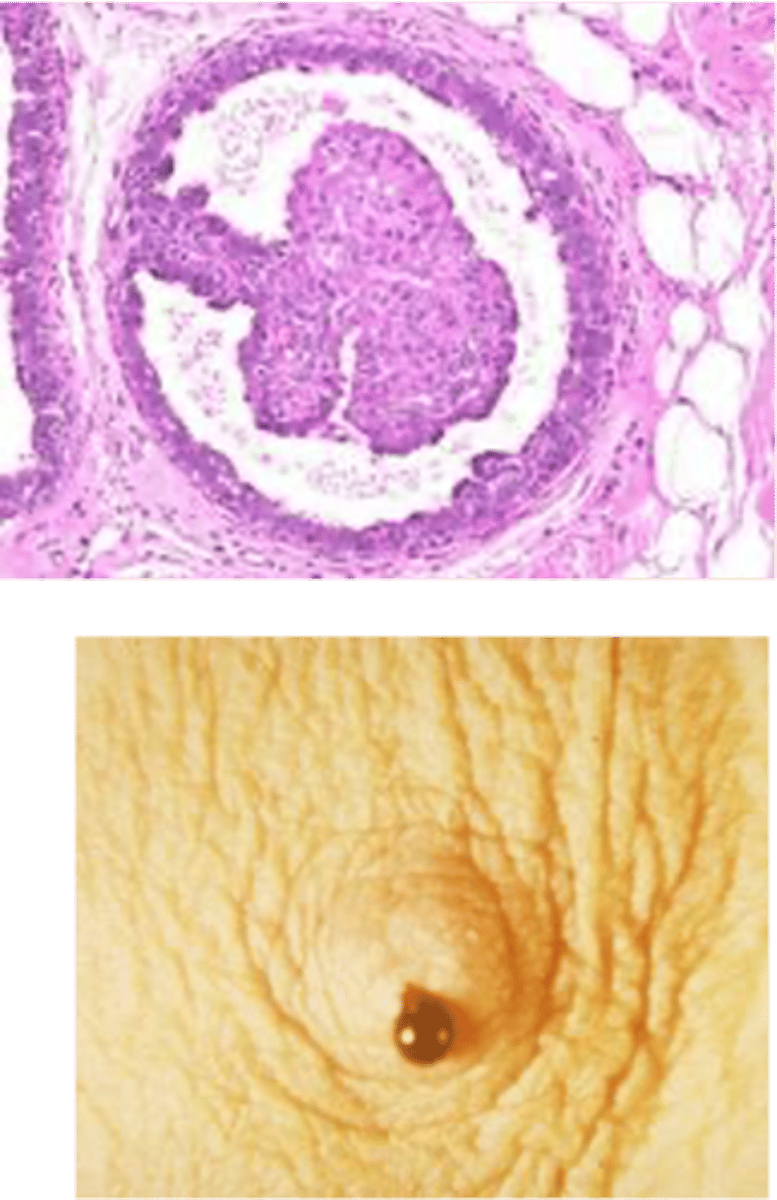 <p>Define Condition:</p><p>Small fibroepithelial tumor w/in lactiferous ducts, typically beneath areola</p><p>-Hx:</p><p>&gt; MCC of Nipple Discharge</p><p>&gt; Close to or at Menopause (&gt; 45 y/o)</p><p>&gt; Usually NOT a/w cancer (slight inc risk)</p><p>-Sx/PE:</p><p>&gt; Serous, Bloody Nipple discharge</p><p>&gt; Rarely Palpable</p><p>-Dx:</p><p>&gt; Mammography</p><p>&gt; Fluid Cytology</p><p>-Tx: EXCISION of lesion &amp; involved duct</p>