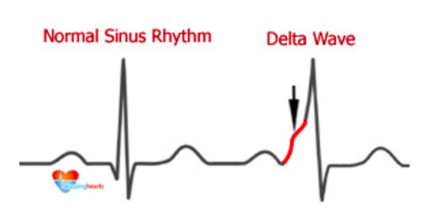 <p>wolff-parkinson white</p><p>kent bundle</p>