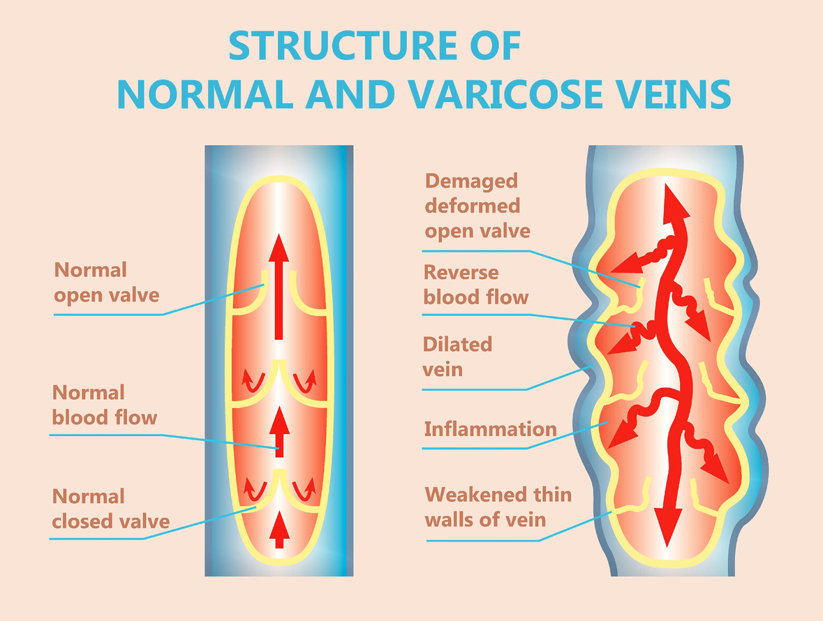 <p><u>Primary</u></p><ul><li><p>consequence intrinsic structural/functional <span style="color: red">abnl in vein wall or venous valves</span> → <span style="color: blue">valvular reflux/regurg. </span></p></li></ul><p><u>Secondary</u></p><ul><li><p>obstruction and/or valvular incompetence from <span style="color: red">previous deep-vein thrombosis. </span></p></li></ul><p></p>