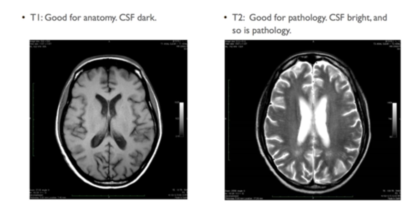 <p>T1- fat is bright (Better for anatomy)</p><p>T2- fluid and fat is bright (Better for Pathology)</p>