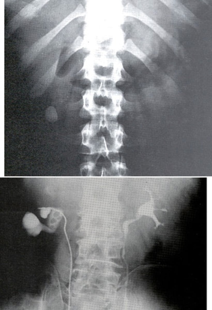 <p>- What hard deposits form in the kidneys from minerals and salts in the urine?</p><p>- What is 80% of these hard deposits made of that causes them to appear radiopaque on a radiograph?</p><p>- What are the other radiolucent hard deposits made of?</p><p>- What is the modality of choice for finding these hard deposits?</p><p>- What radiographic exam shows points where the ureters are obstructed and filling defects caused by the hard deposits?</p><p>- Where do these hard deposits usually obstruct?</p>