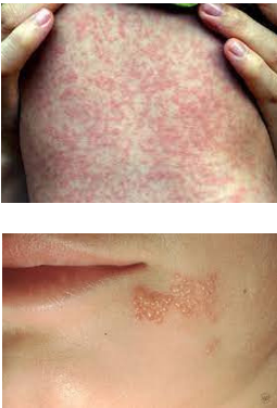 <ul><li><p><strong>Viral Exanthem:</strong></p><ul><li><p><strong><em>Ex</em>:</strong> Hand, foot, and mouth disease.</p></li><li><p>A rash.</p></li><li><p>Can look serious; if you rub or wipe the baby's back, the rash will fade and then reappear.</p></li><li><p>Bothers others more than the baby.</p></li></ul></li><li><p><strong>Herpes Simplex:</strong></p><ul><li><p>Pearly, clustered lesions.</p></li></ul></li></ul><p></p>