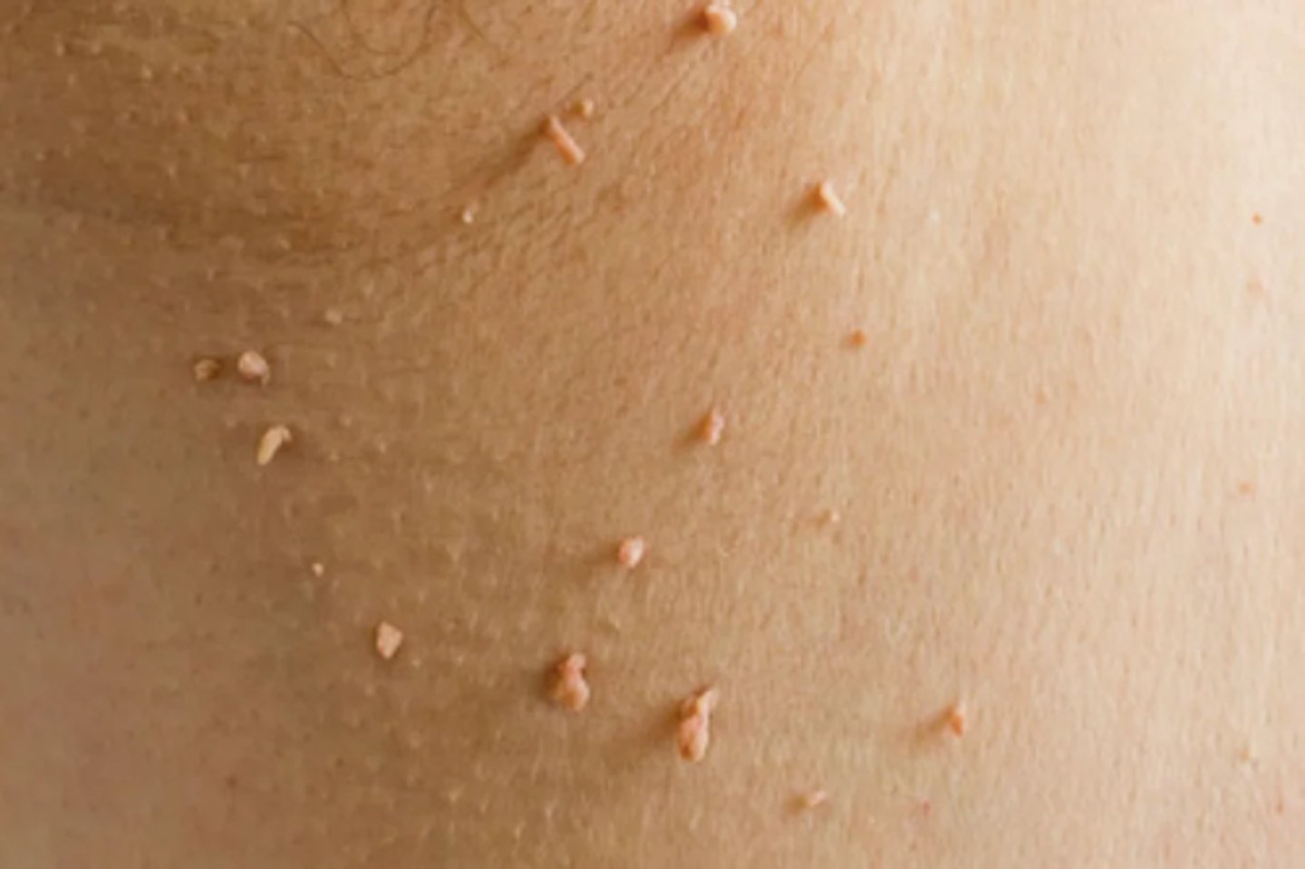 <p>What are causes of skin tags?</p>