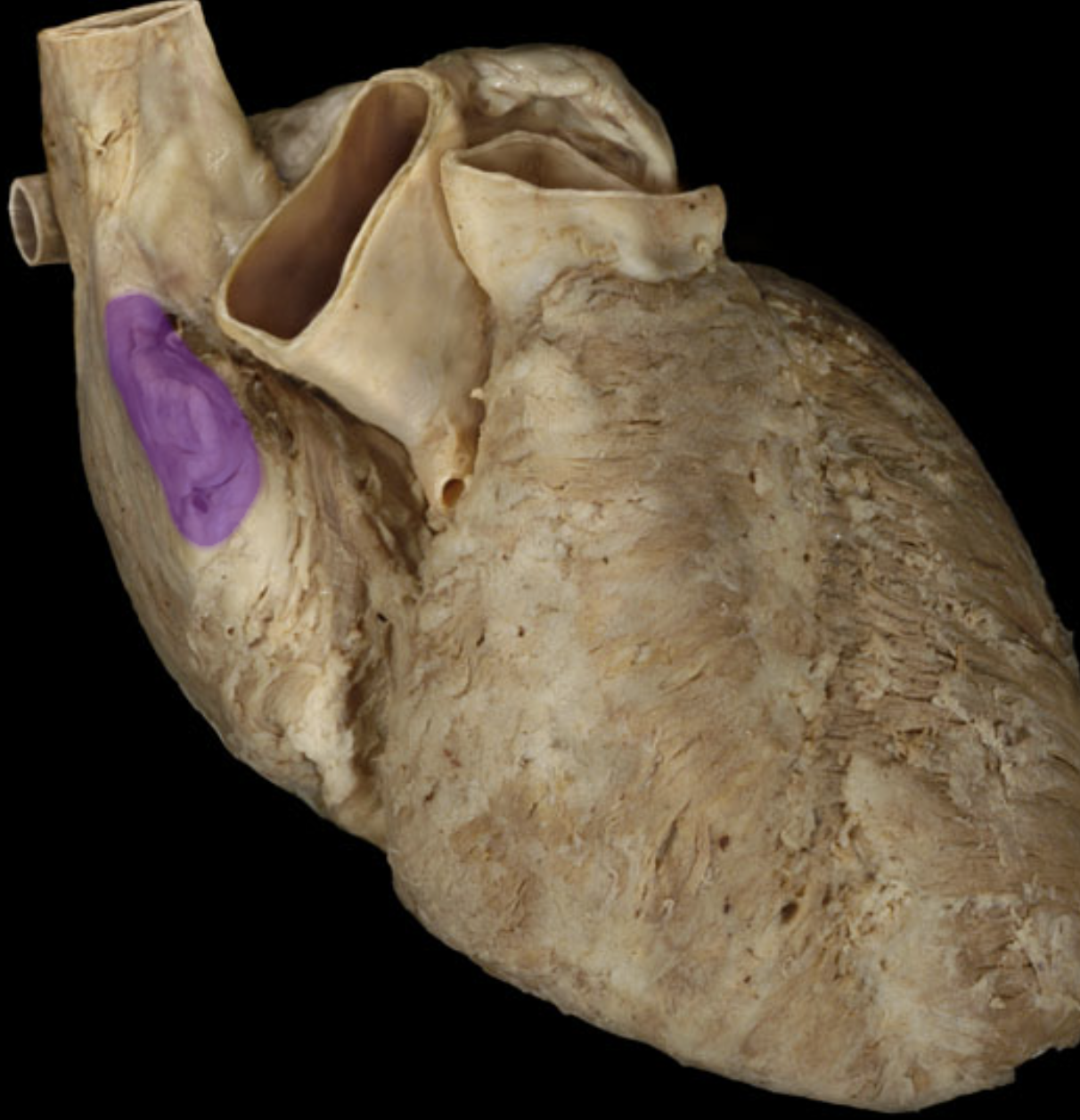 <p>right auricle</p>