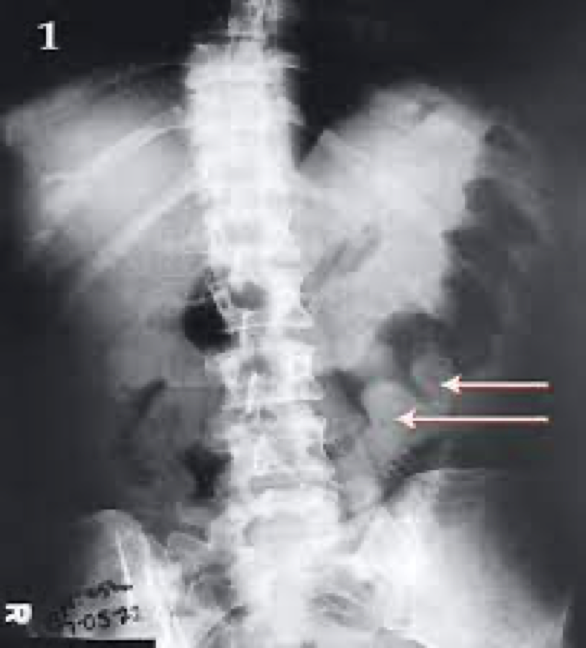 <p>On xray-deep ulcers, pseudopolyps, finger-like indentations along colon wall</p>