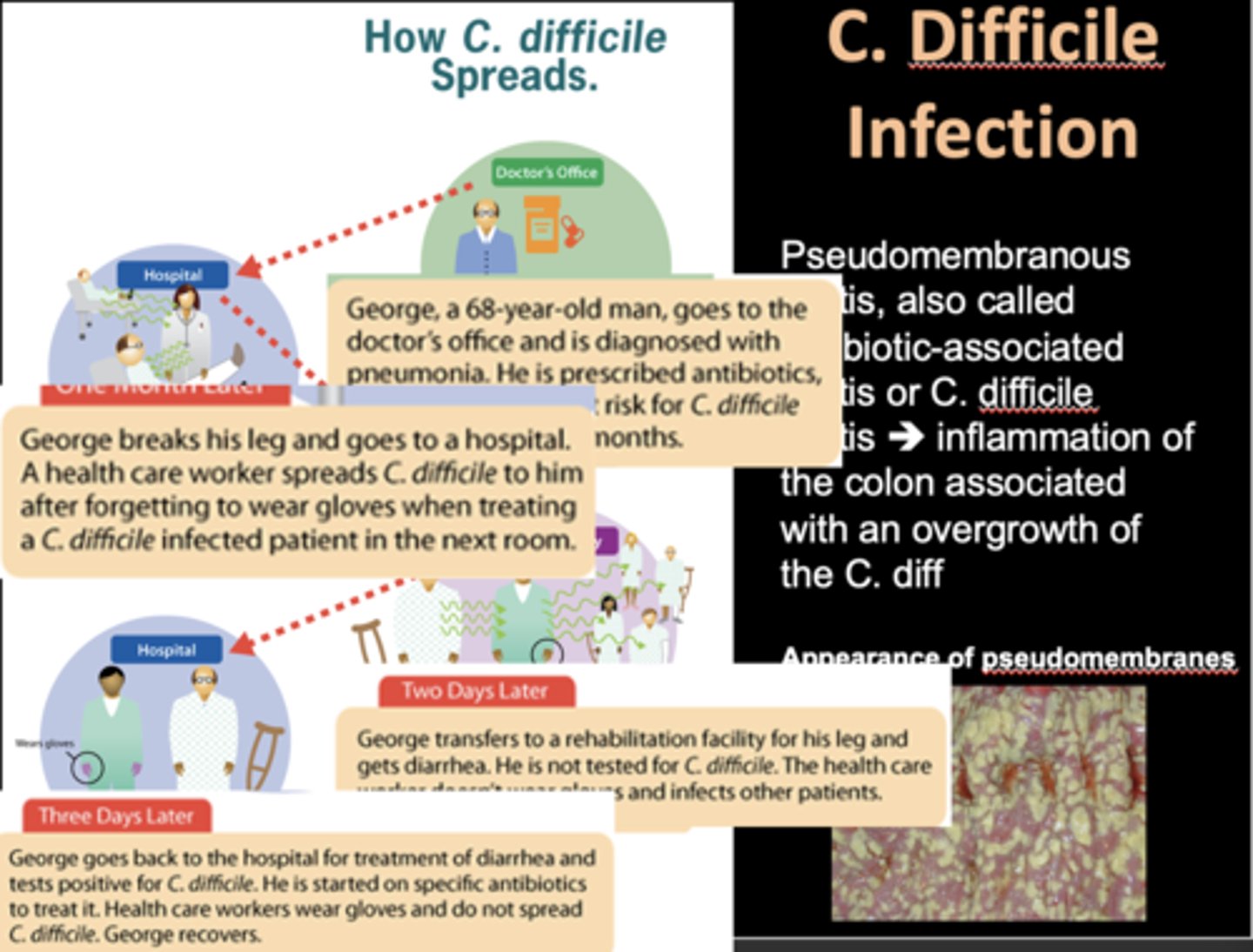 <p>Chlostridium Difficile Infection</p>