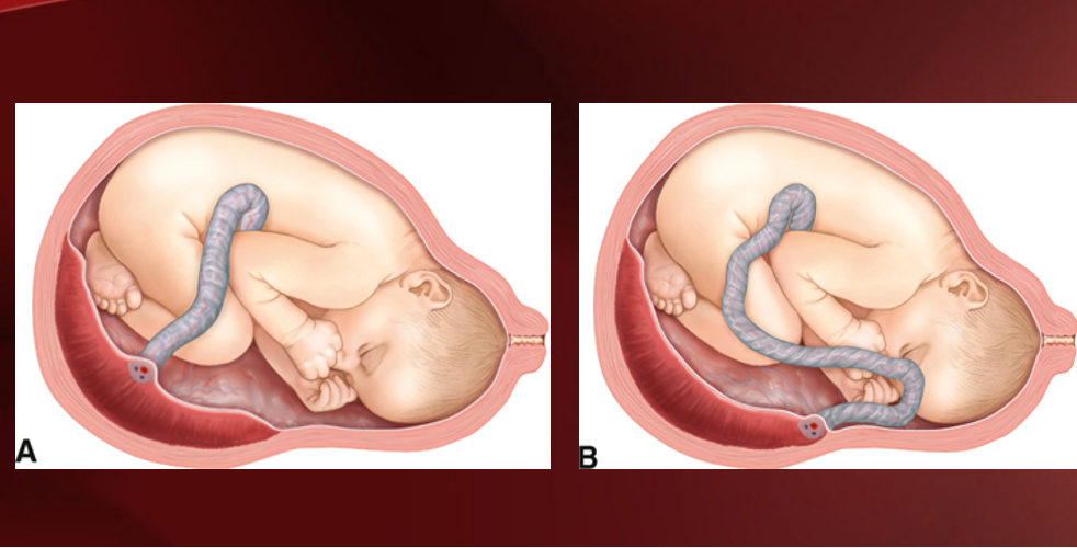 <p>umbilical cord inserts near edge of placenta</p><p>a= normal insertion; b= battledore insertion</p>