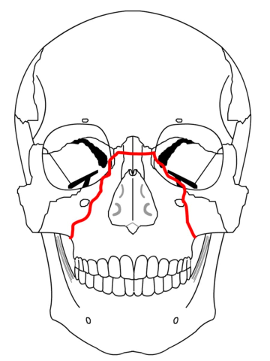 <p>Fracture that extends up through the orbital floor, through the orbital wall and down the nasal bones</p>