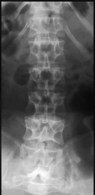 <p>what is seen here for this case of achondroplasia?</p>