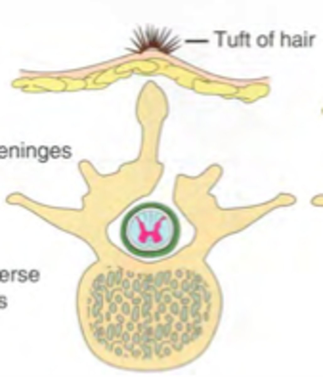 <p>Aka rachischisis; fissure in spinal column that leaves meninges and spinal cord exposed</p>