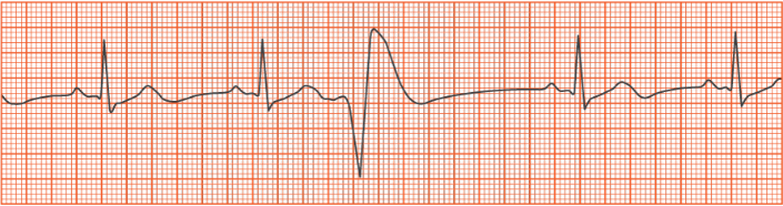 <p>The pictured rhythm is an example of which of the following?</p><p></p><p>A. Premature ventricular contraction</p><p>B. Ventricular tachycardia</p><p>C. Sinus bradycardia</p><p>D. Atrial flutter</p>