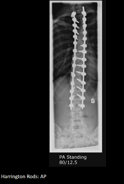 <p>Milwaukee brace; for flexible, skeletally immature patients with 20–40° progressive curves.</p>