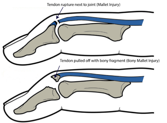 <p>Traumatic terminal <strong>extensor tendon injury (EDC) Rupture or Avulsion,</strong> forced DIPJ flexion</p><p><u>Clinical Presentation:</u> Pain, swelling, <strong>fixed flexion deformity,</strong> lump, <strong>inability to extend, </strong>subungual hematoma?</p><p><u>Diagnosis:</u> <strong>MOI</strong>, observation, <strong>TOP </strong>to DIPJ, inability to extend DIP, radiograph, palpation of nail bed</p><p><u>Management</u>: Conservative, full time splint, strength &amp; control, surgery, tendon reconstruction, bracing following surgery</p><p><u>Risk factors:</u> cricket, basketball, volleyball, slammed in door, males, dominant side, <strong>Swan-neck deformity</strong></p>
