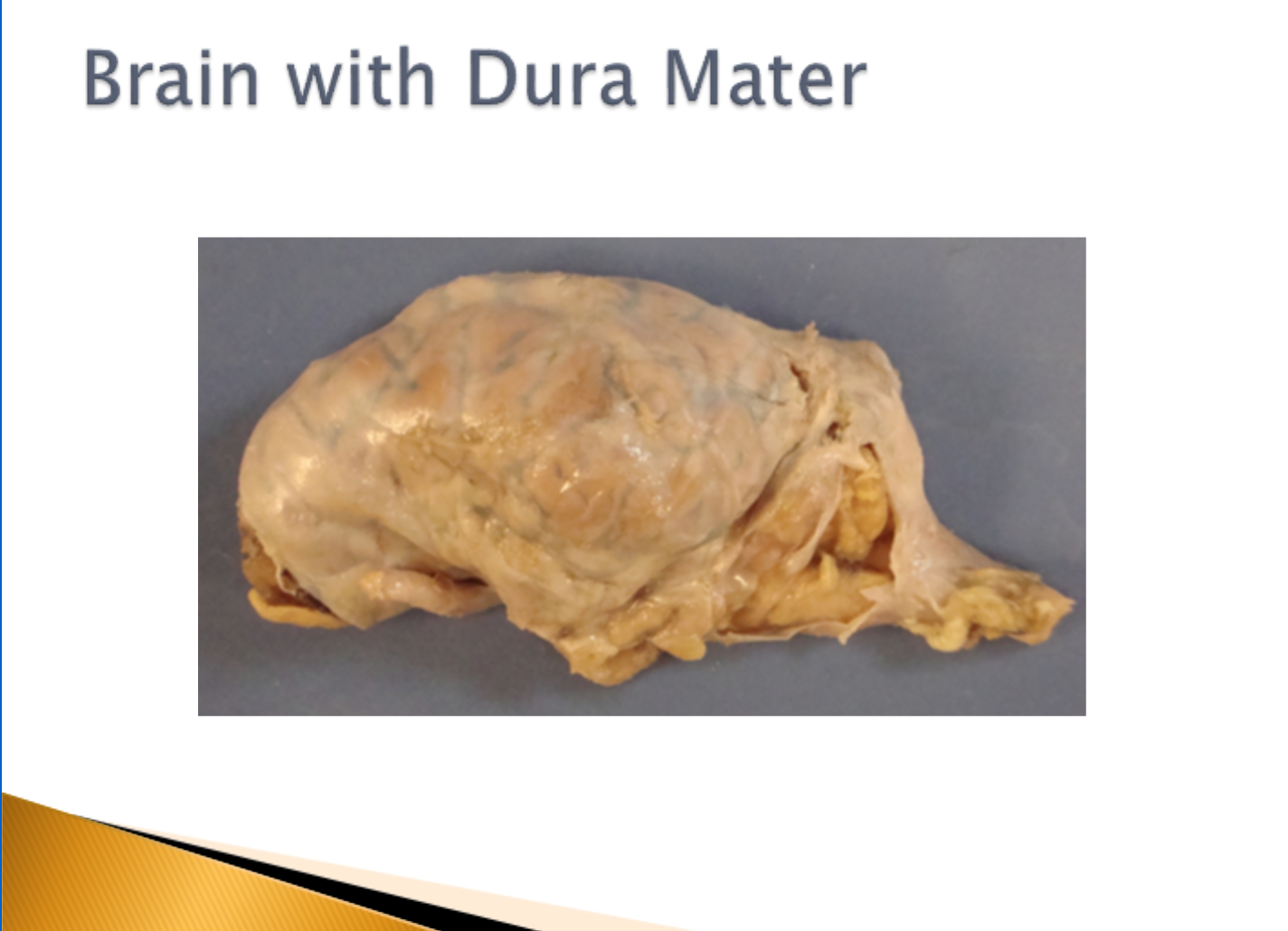 <p>Brain with Dura Mater</p>