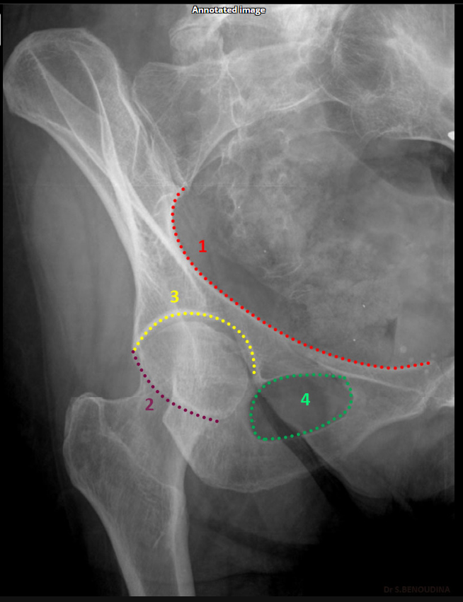 <p>Anterior column.(SHOWN #1 RED)</p>