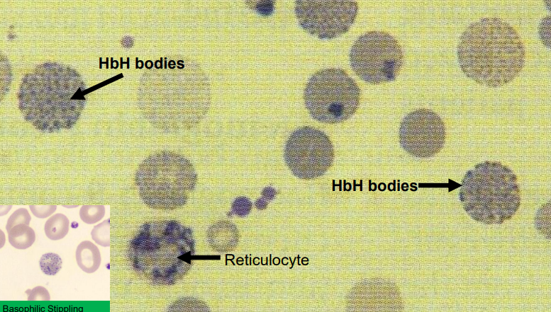 <p>from alpha thalassaemia</p><p>different from reticulocytes</p>