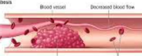 <p>Formation of solid blood clot within blood vessel</p>