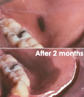 <p>what is the cause of this lesion</p>