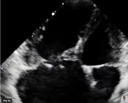 <p><span>TR caused by____________is&nbsp;<strong>most often post-traumatic, is caused by endocarditis or is a consequence of a myxomatously degenerated valve</strong>.</span></p>