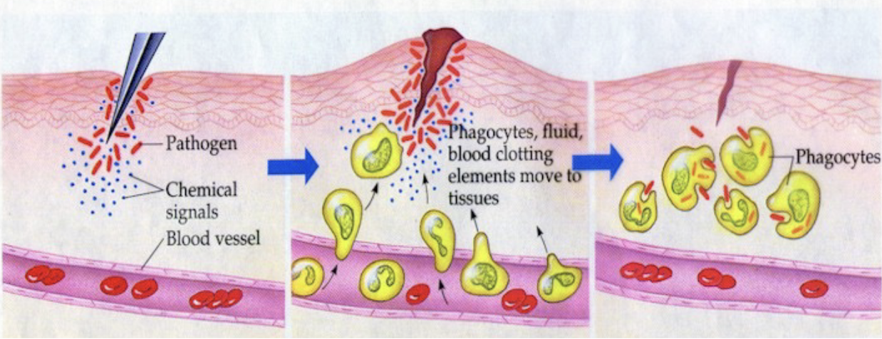 <ol><li><p>Redness (increased blood flow)</p></li><li><p>Heat (high temperature due to increased blood flow)</p></li><li><p>Swelling</p></li><li><p>Pain</p></li></ol><p></p>