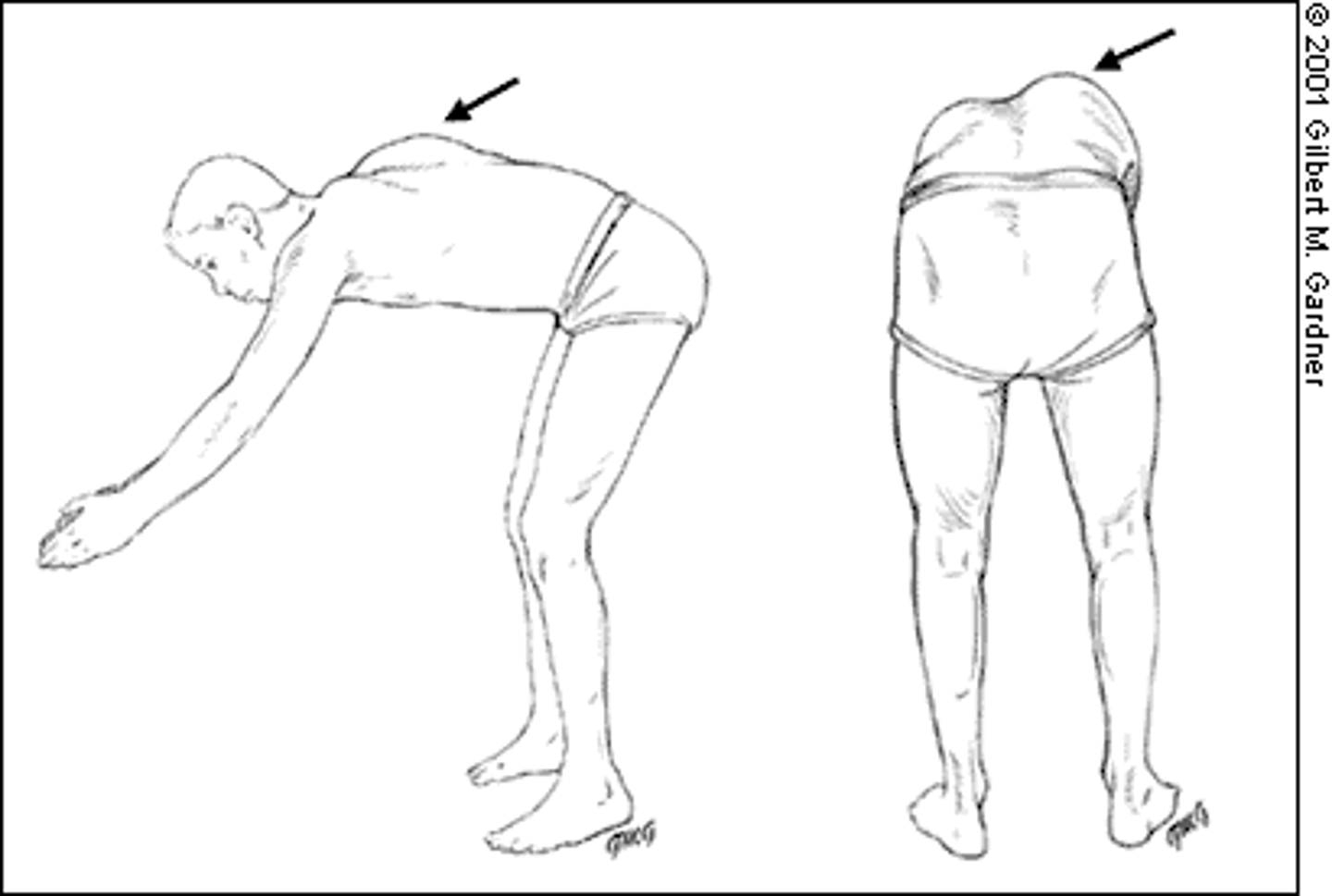 <p>positive finding in forward bending test for scoliosis</p>