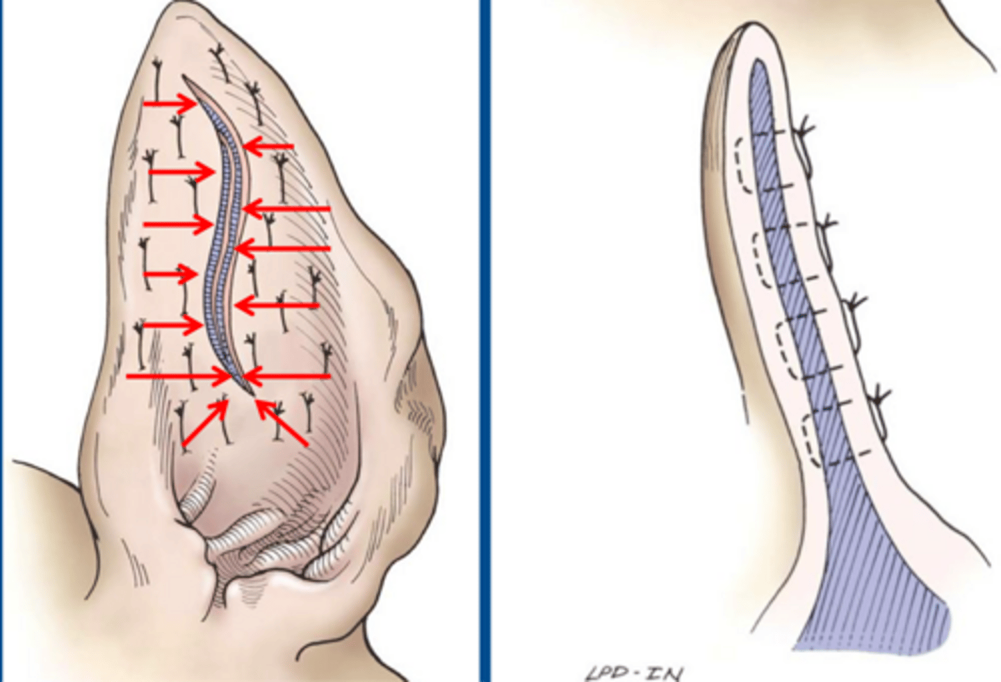 <p>characteristics of aural hematoma tx.</p>