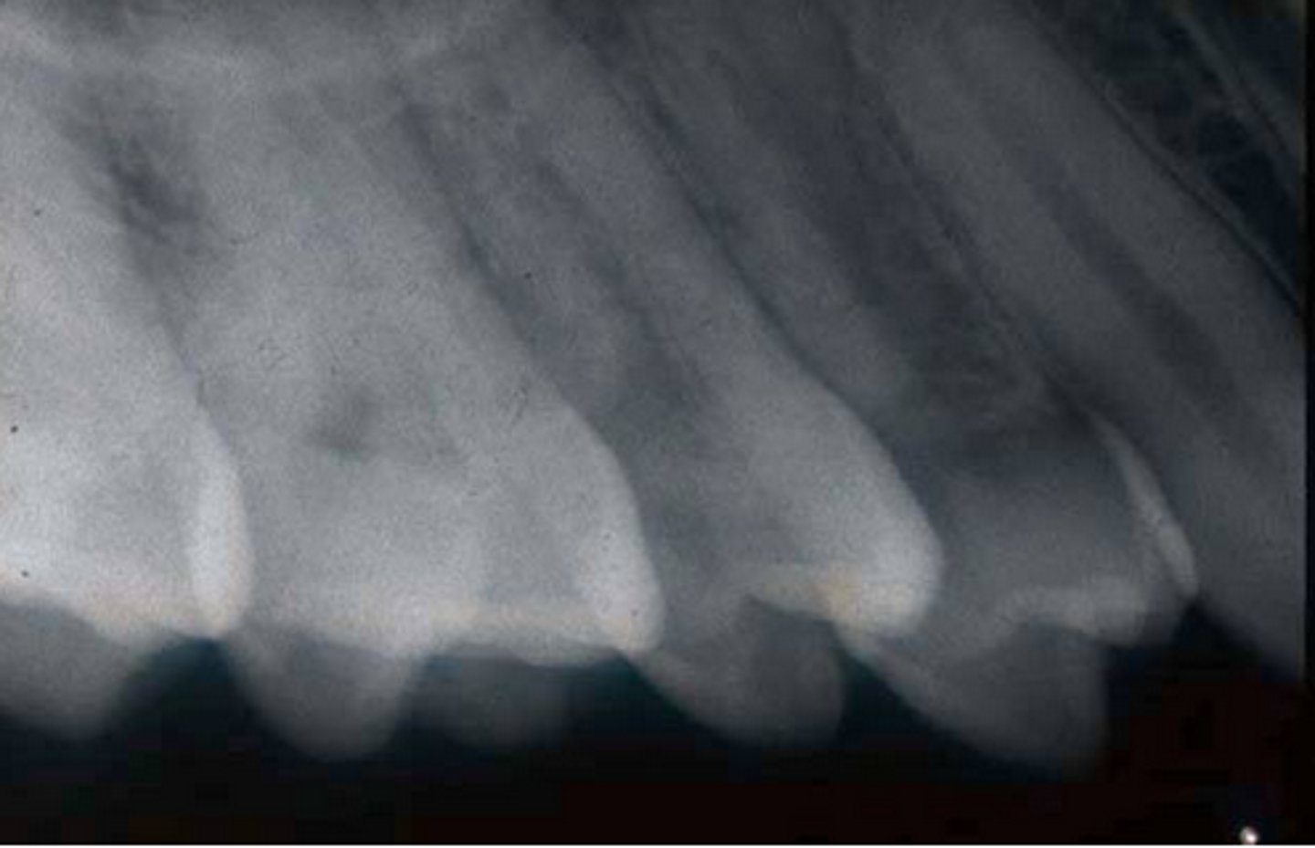 <p>insufficient vertical angulation</p><p>teeth appear longer than actual size</p>