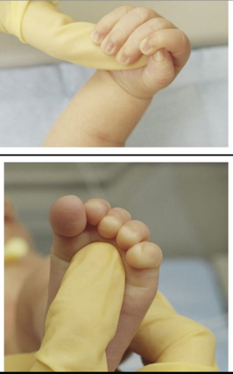 <p>touch palm or ball of foot, baby will close hand or curl toes around object</p><p>- develops 28 weeks gestation</p><p>- integrates:</p><p>- palmar: 4-7 months</p><p>- plantar: 9 months</p>