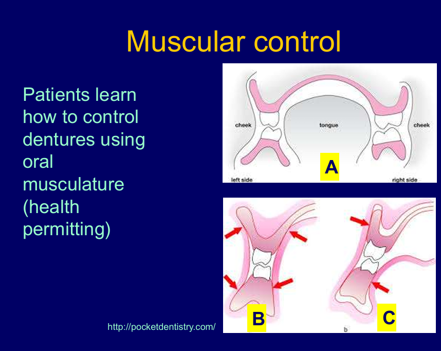 <p>Muscles from cheek and tongue should balance out - dentures more likely to stay in place - A and B - where the forces are acting</p><p>C-  muscles can start to dislodge dentures -  teeth are too far buccal so muscle push back </p><p>in the lower arch it is too lingual so muscle of tongue push back on denture causing it to lift</p><p>suction effect in lower is more difficult and if its not great suction and not provided much space for tongue denture can move</p>