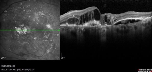 <p>The OCT would show the presence of fluid accumulation between the RPE and Bruch’s membrane, as well as possible separation of the RPE from the membrane.</p>