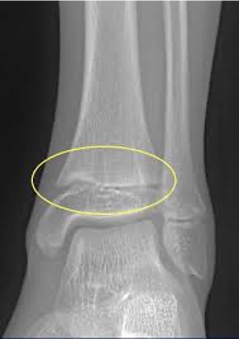 <p>what type of salter Harris fracture is this? what kind of tx is needed?</p>