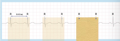 <ul><li><p>Look at the R peaks to see if they are evenly spaced</p></li><li><p>Take a piece of paper and move it between R peaks to check</p></li></ul><p></p>