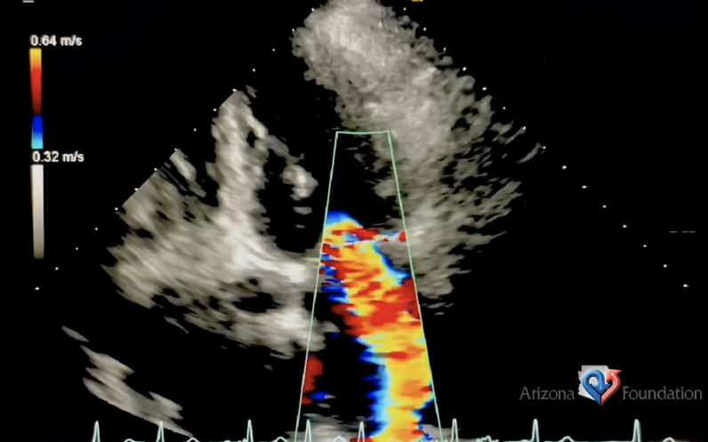 <p>What Doppler findings are expected from this exam?</p>