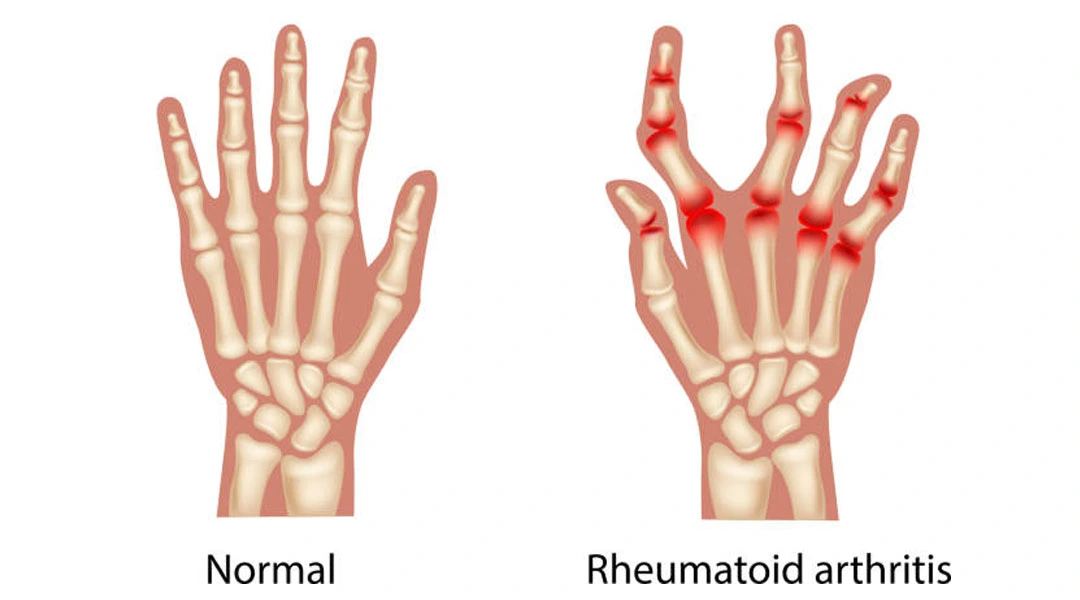 <p>Autoimmune disease attacking joint linings. <span>Often starts in the small joints of the hands and feet, particularly the fingers, wrists, and ankles</span></p>