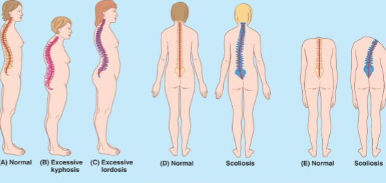 <p>Kyphosis, Lordosis, and Scoliosis</p>