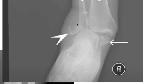 <p>What type of Ankle Malleolar Fx is this? </p>